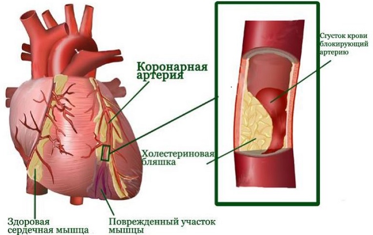 myocardial-infarction-768x533.jpg