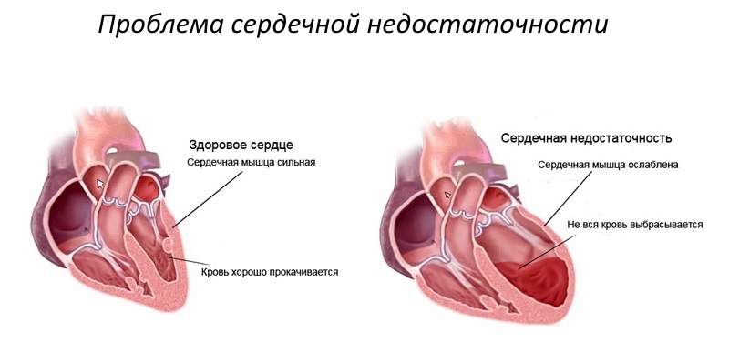 Схема-сердечной-недостаточности.jpg