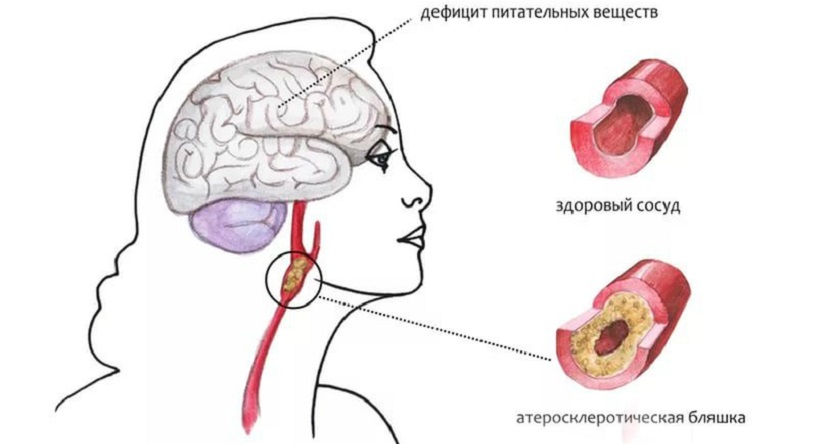 Симптомы атеросклероза сосудов головного мозга